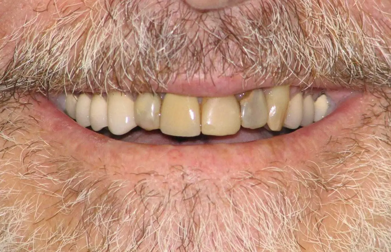 cosmetic-dentistry-case-1-before-2-new cosmetic-dentistry-case-1-before-2-new