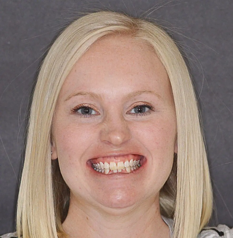 invisalign-before-after-edited_5 invisalign-before-after-edited_5