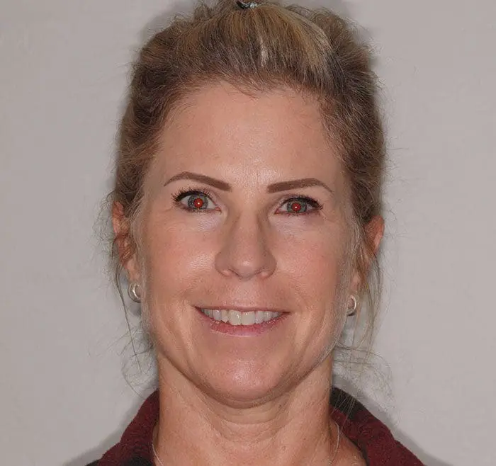 invisalign-case-10-full-face-before-image invisalign-case-10-full-face-before-image