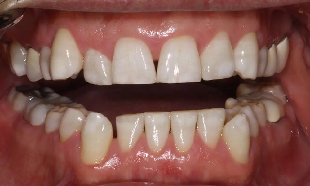 invisalign-case-19-before-image invisalign-case-19-before-image