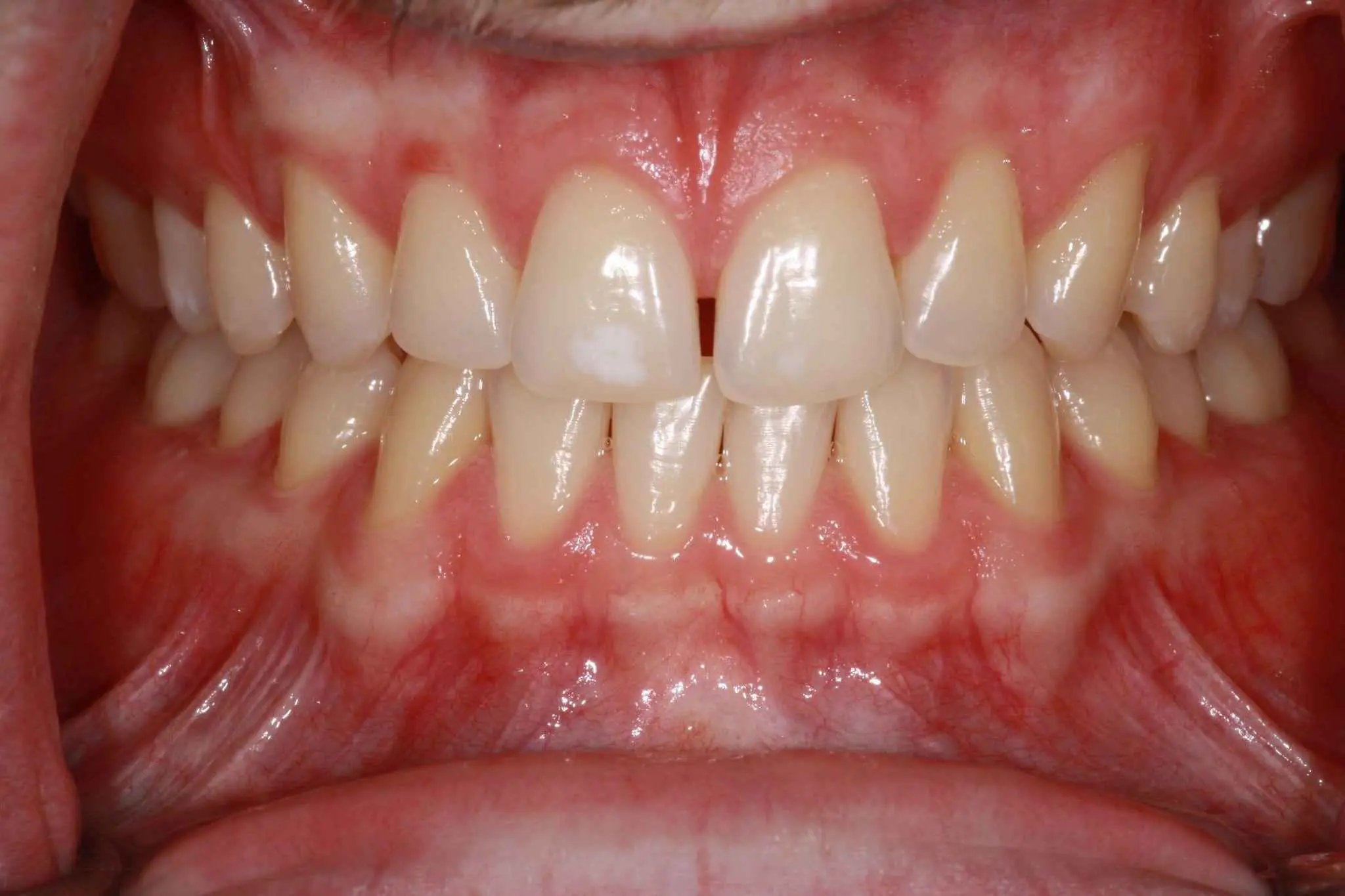 veneers-and-iInvisalign-case-5 veneers-and-iInvisalign-case-5