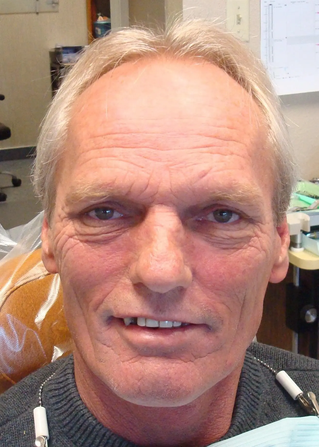 dentures-and-Implants-case-before dentures-and-Implants-case-before