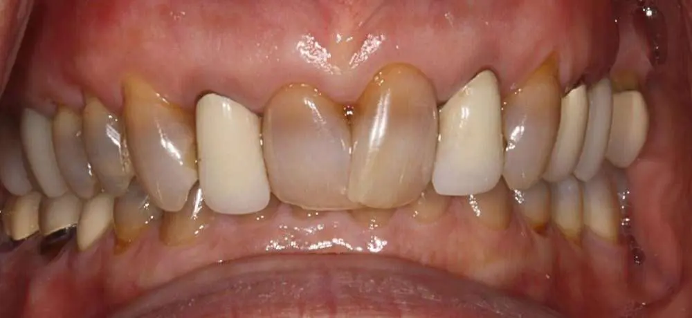 Cosmetic-Dentistry-Case-2-Part-3 Cosmetic-Dentistry-Case-2-Part-3