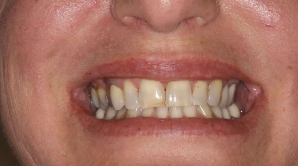 Cosmetic-Dentistry-Case-3-Part-3 Cosmetic-Dentistry-Case-3-Part-3