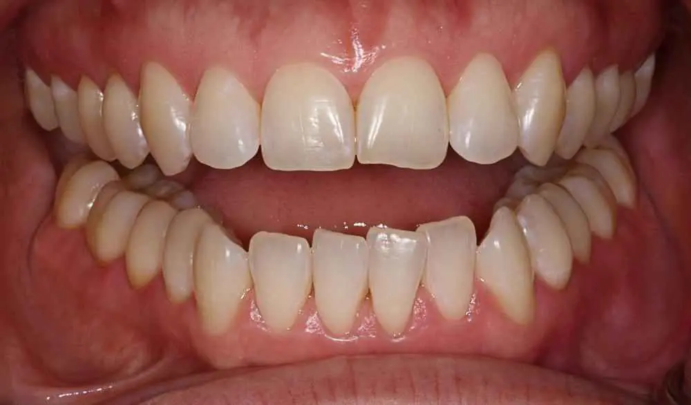 Invisalign-Before-After-13 Invisalign-Before-After-13