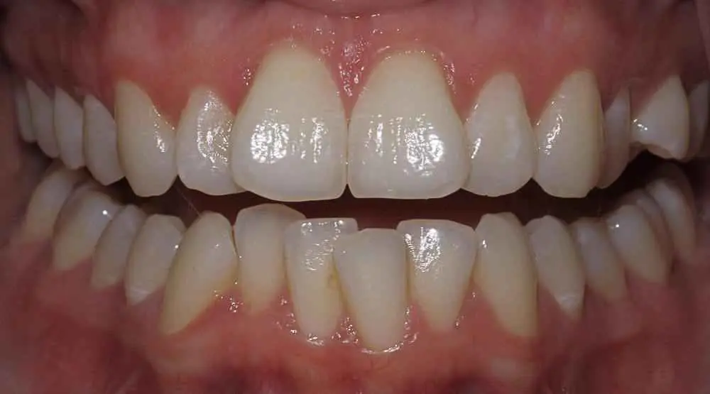 Invisalign-Before-After-17 (1) Invisalign-Before-After-17 (1)