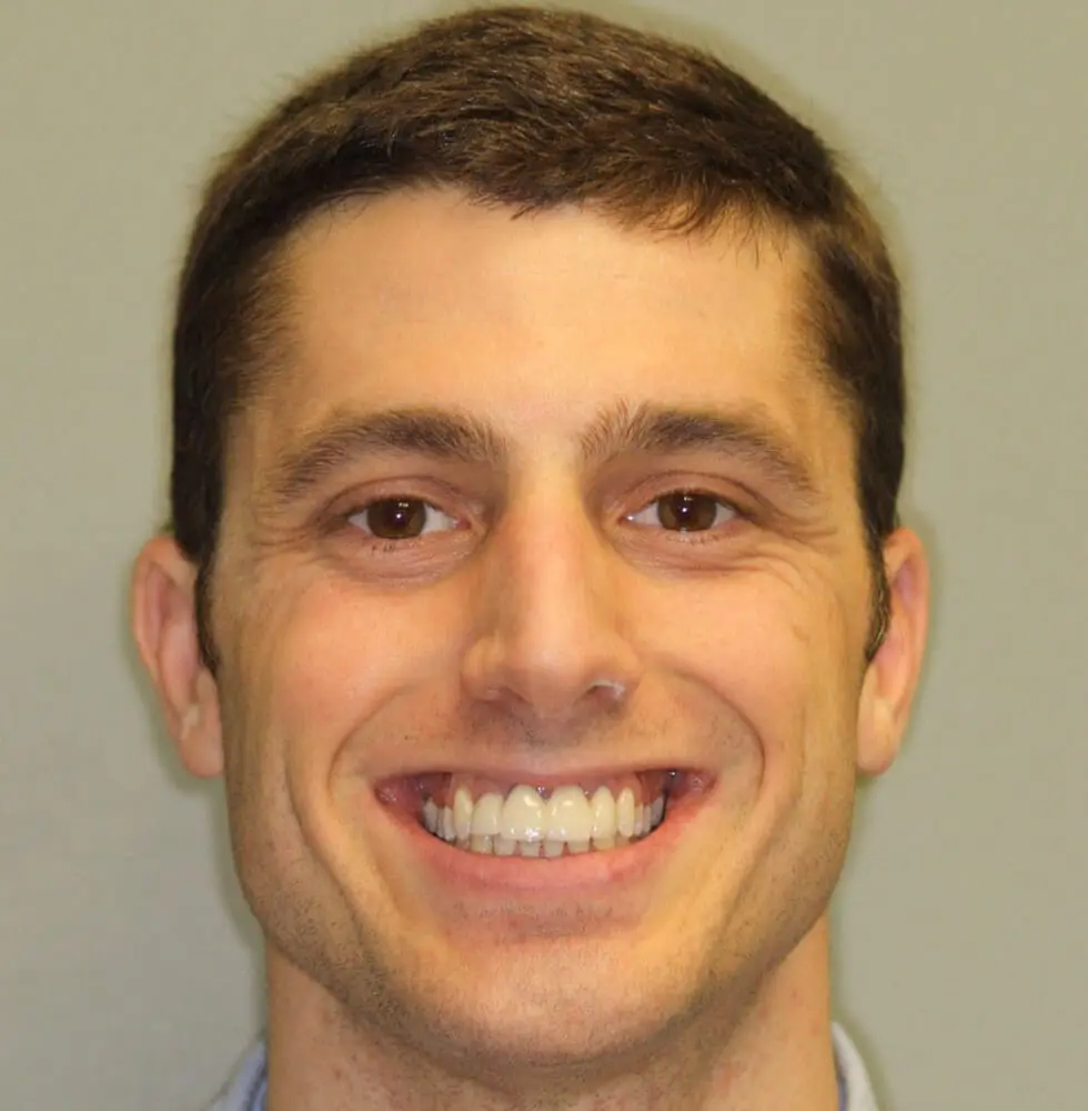 invisalign-bna-case-18-before invisalign-bna-case-18-before