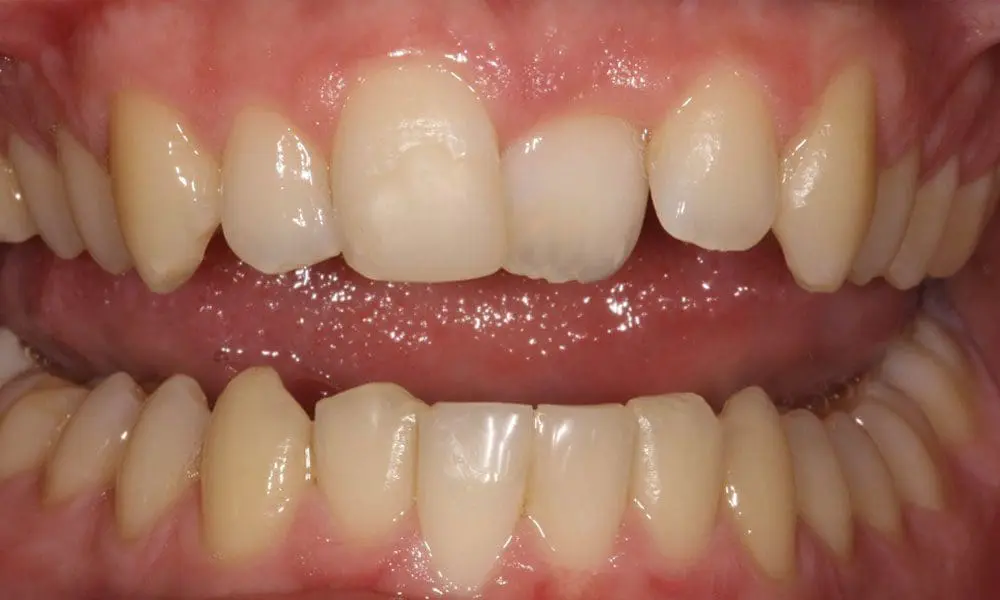 invisalign-case-12-before-image-2 invisalign-case-12-before-image-2