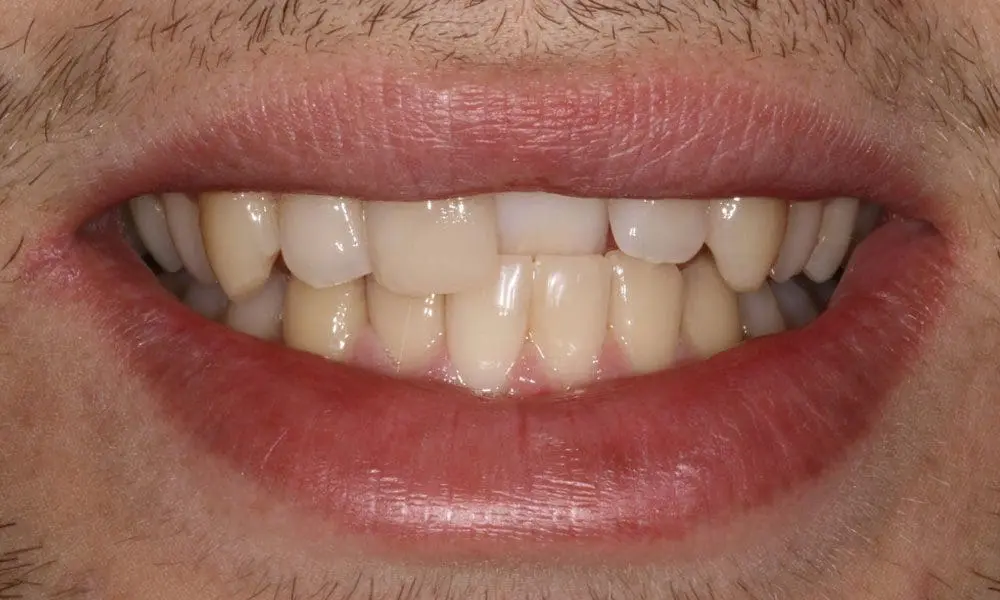 invisalign-case-12-before-image invisalign-case-12-before-image