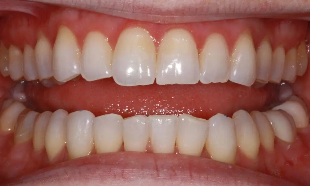 invisalign-case-13-after-image invisalign-case-13-after-image