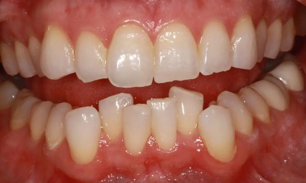 invisalign-case-13-before-image invisalign-case-13-before-image