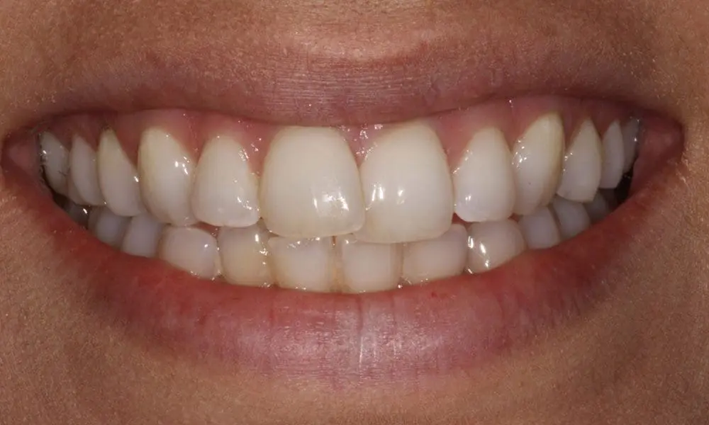 invisalign-case-14-before-image-2 invisalign-case-14-before-image-2