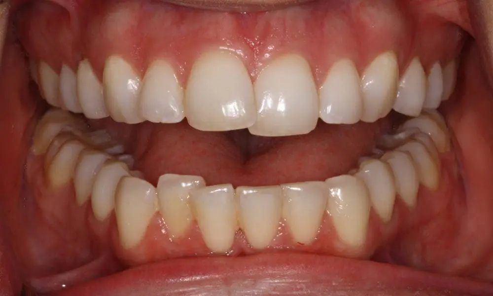 invisalign-case-14-before-image invisalign-case-14-before-image