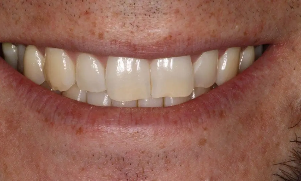 invisalign-case-15-before-image-2 invisalign-case-15-before-image-2