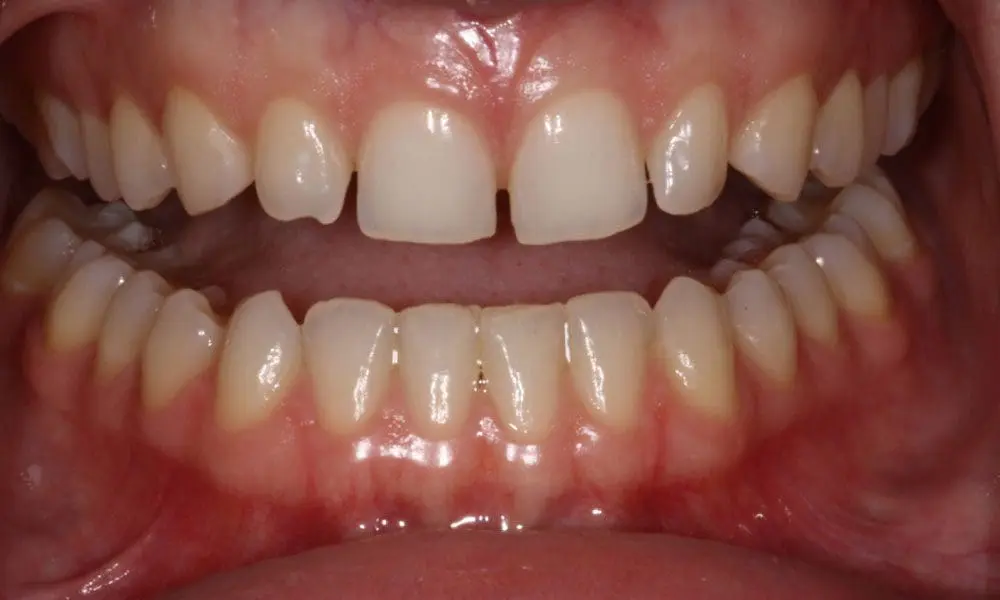 invisalign-case-16-before-image invisalign-case-16-before-image