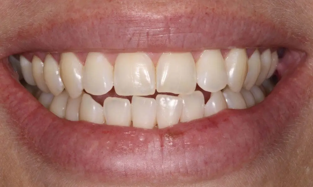 invisalign-case-17-after-image-2 invisalign-case-17-after-image-2