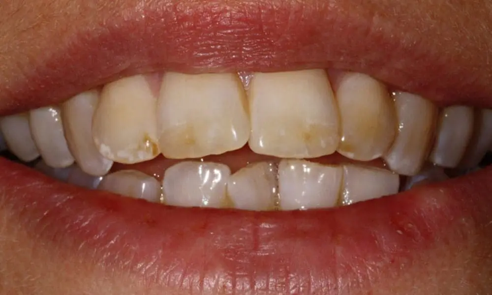 invisalign-case-18-before-image-2-new invisalign-case-18-before-image-2-new