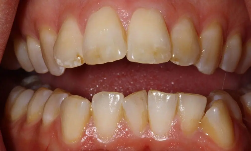 invisalign-case-18-before-image invisalign-case-18-before-image