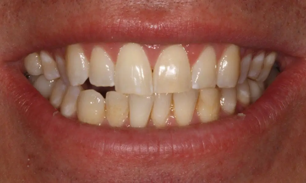 invisalign-case-20-before-image-2 invisalign-case-20-before-image-2