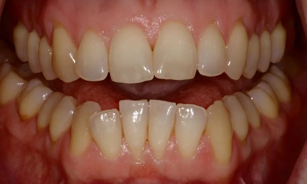 invisalign-case-21-before-image invisalign-case-21-before-image