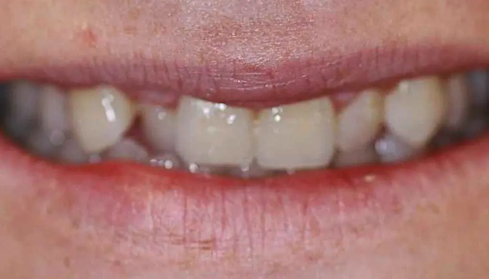 invisalign-case-24-after-image-1-new invisalign-case-24-after-image-1-new