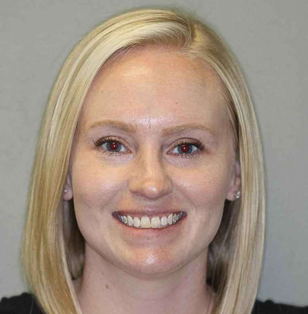 Invisalign-Before-After-Edited-6