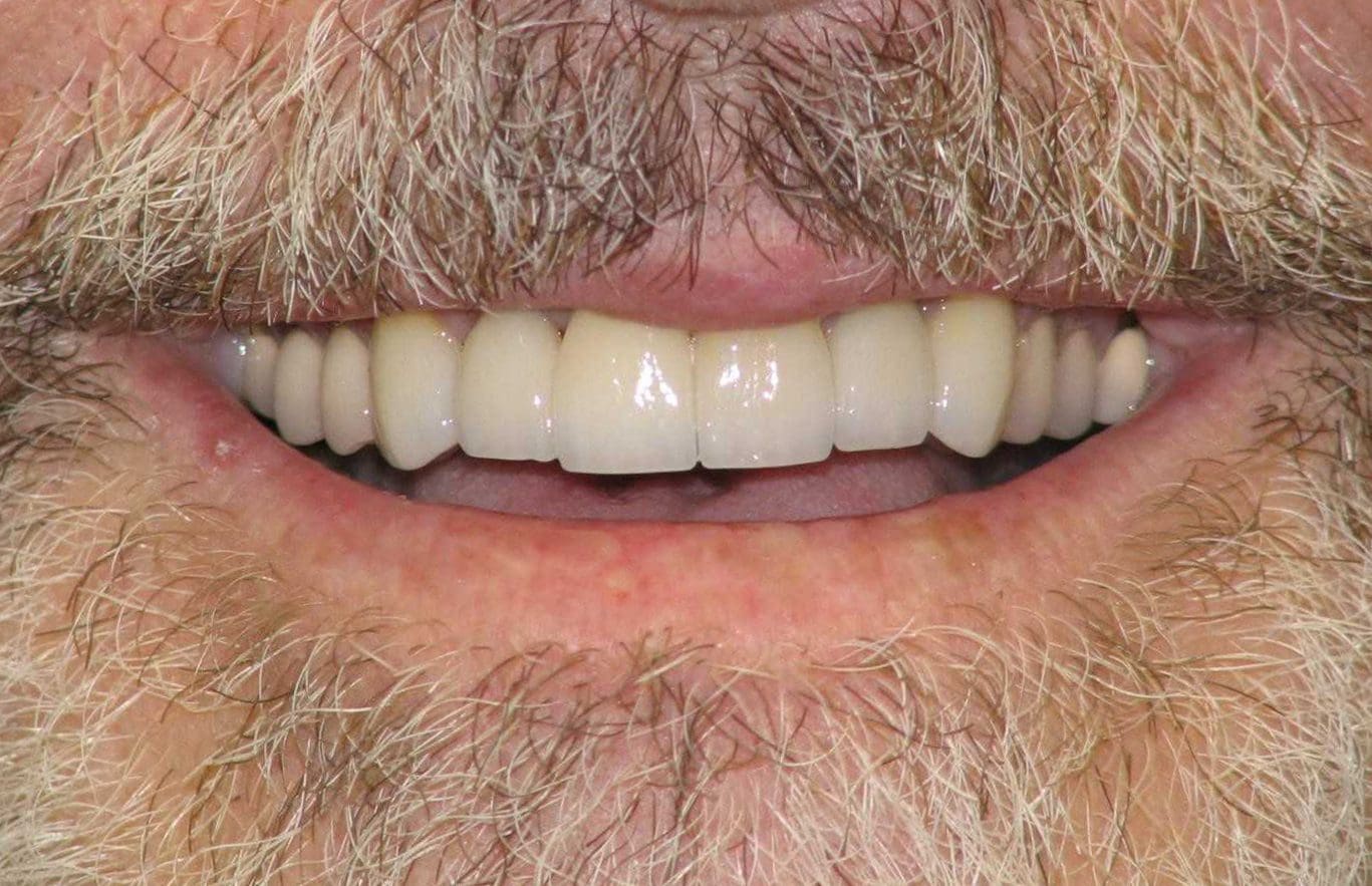 cosmetic-dentistry-case-1-after-2-new