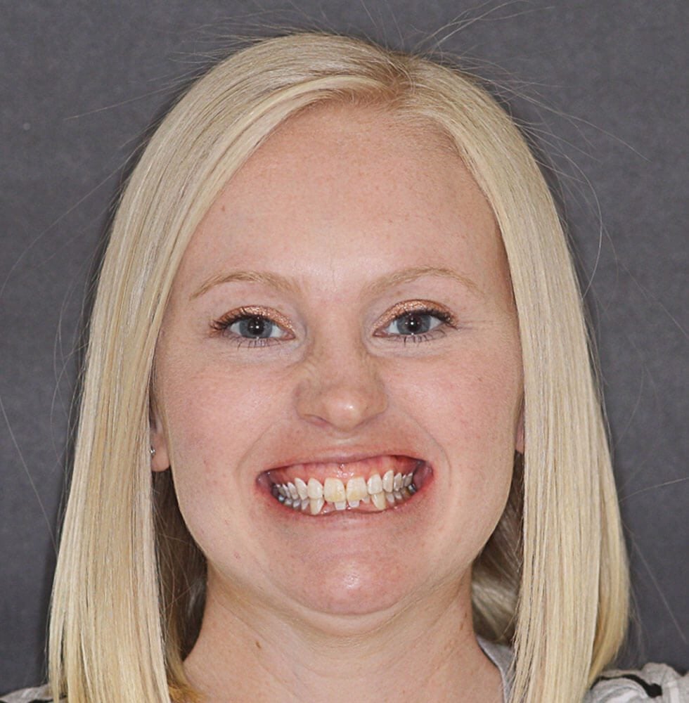 invisalign-before-after-edited_5 invisalign-before-after-edited_5