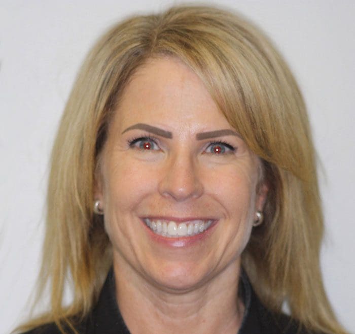 invisalign-case-10-full-face-after-image