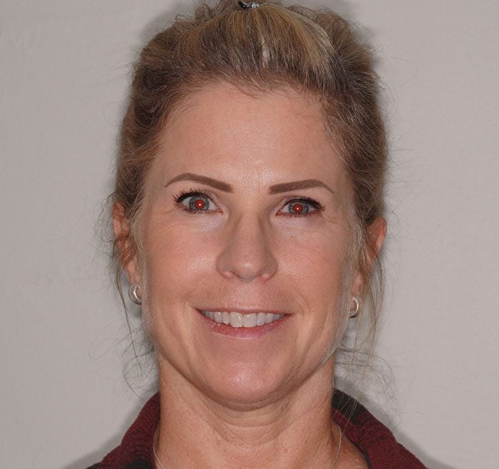 invisalign-case-10-full-face-before-image invisalign-case-10-full-face-before-image