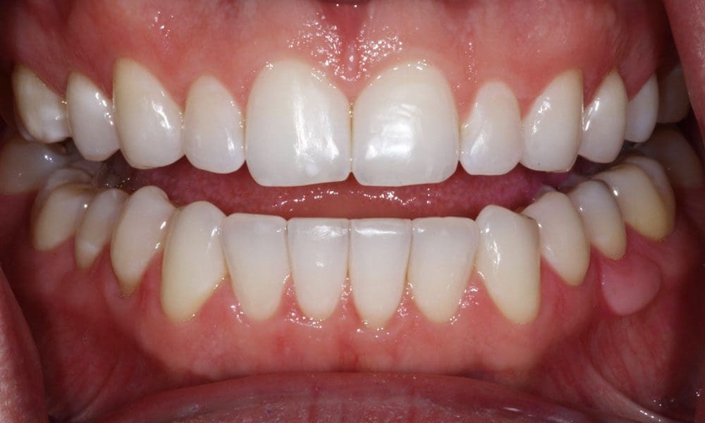 invisalign-case-11-after-image