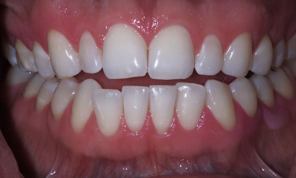 invisalign-case-11-before-image invisalign-case-11-before-image