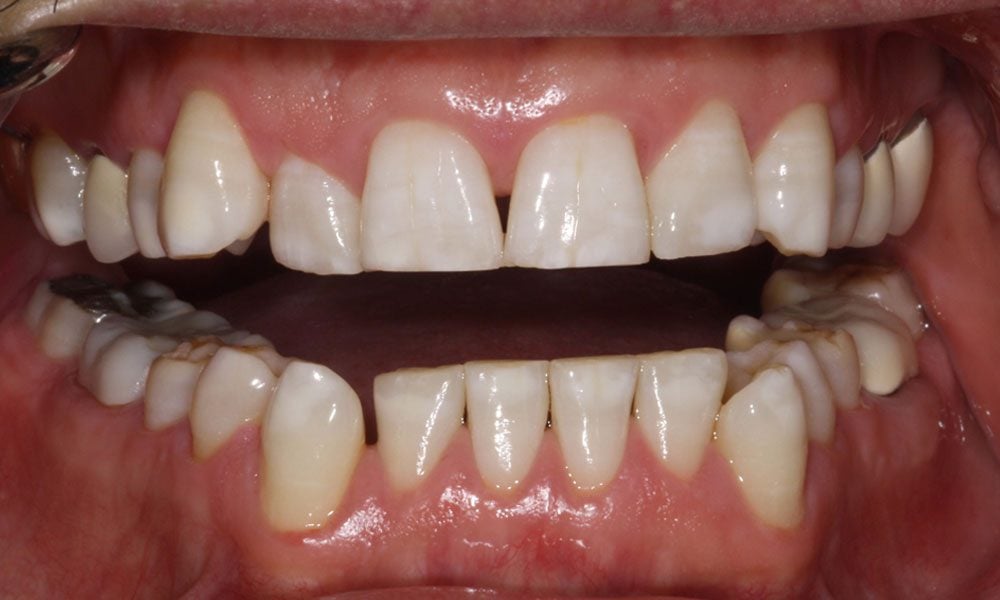 invisalign-case-19-before-image invisalign-case-19-before-image