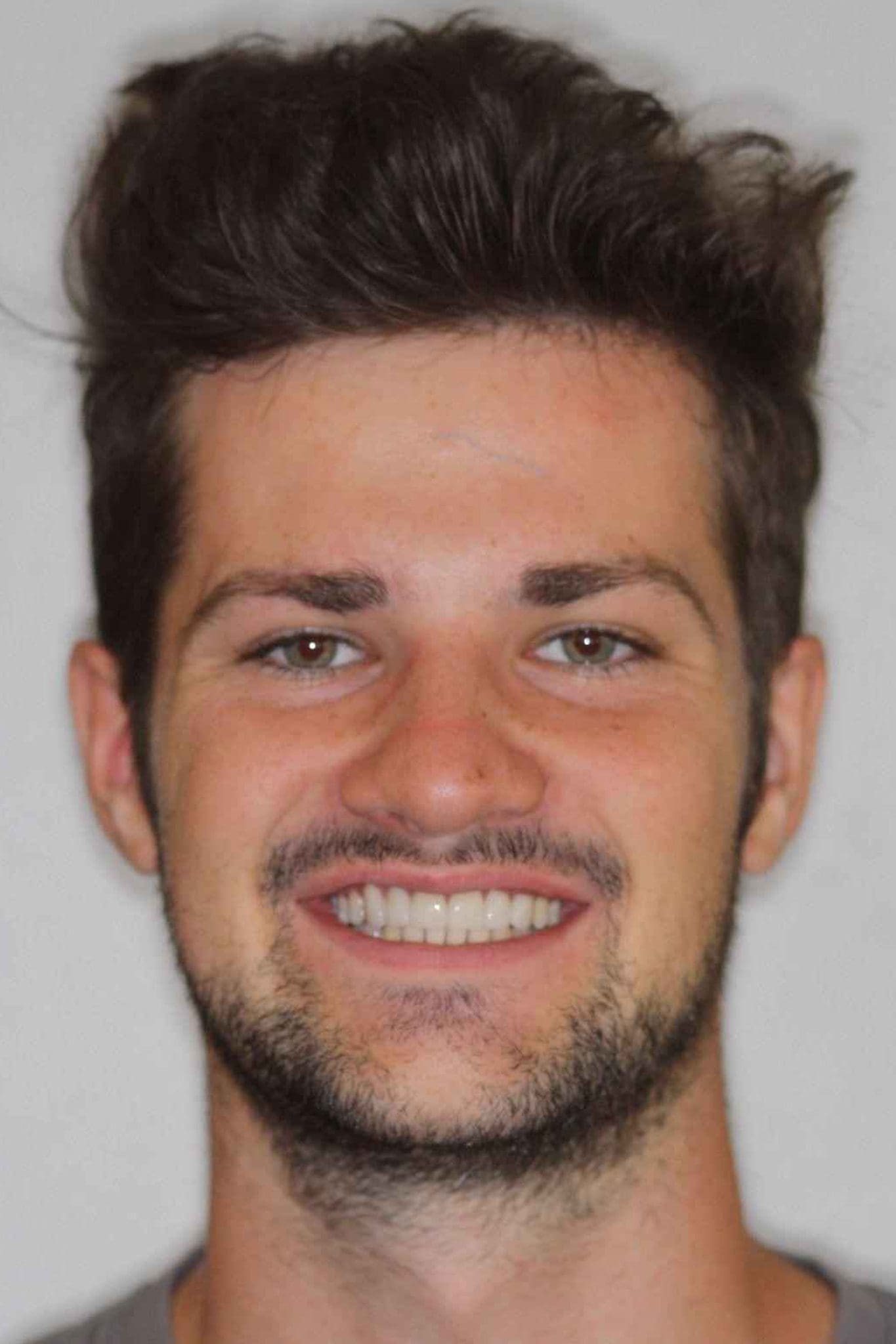 veneers-and-iInvisalign-case-1-after-new