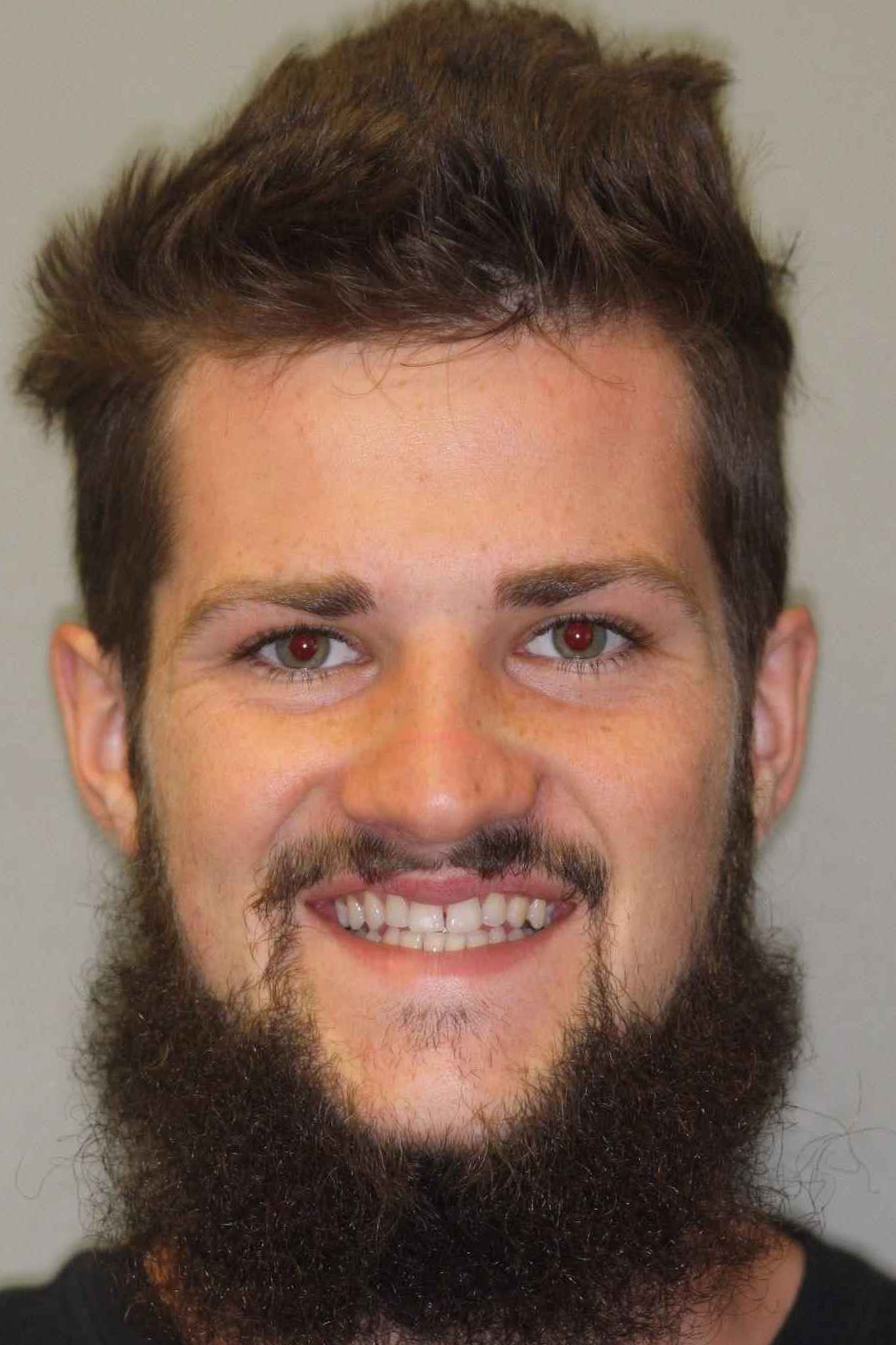 veneers-and-iInvisalign-case-1-before-new veneers-and-iInvisalign-case-1-before-new