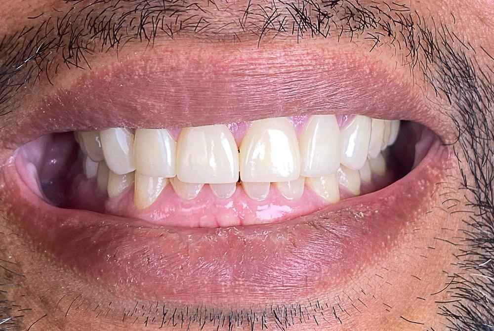 veneers-and-iInvisalign-case-10
