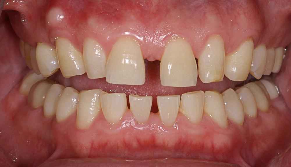 veneers-and-iInvisalign-case-11 veneers-and-iInvisalign-case-11