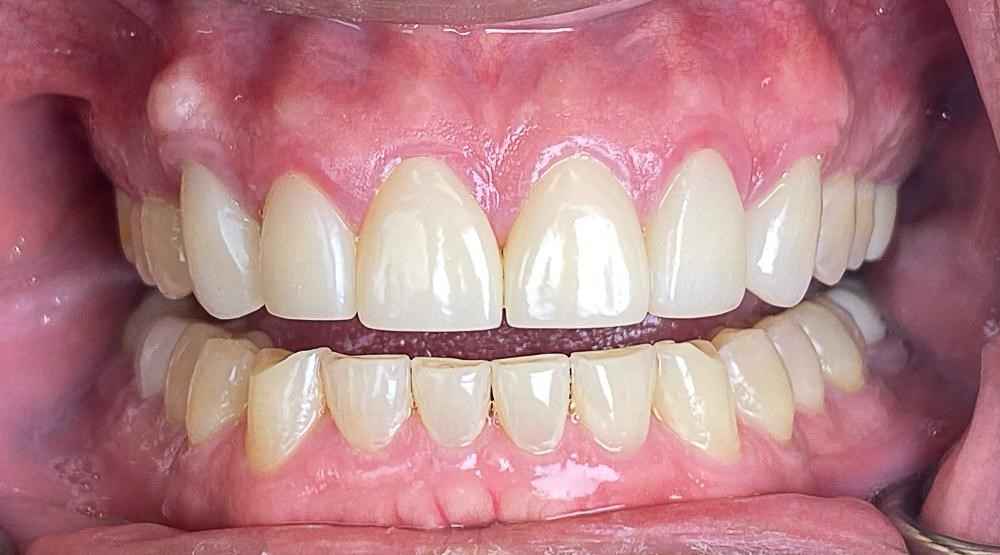 veneers-and-iInvisalign-case-12
