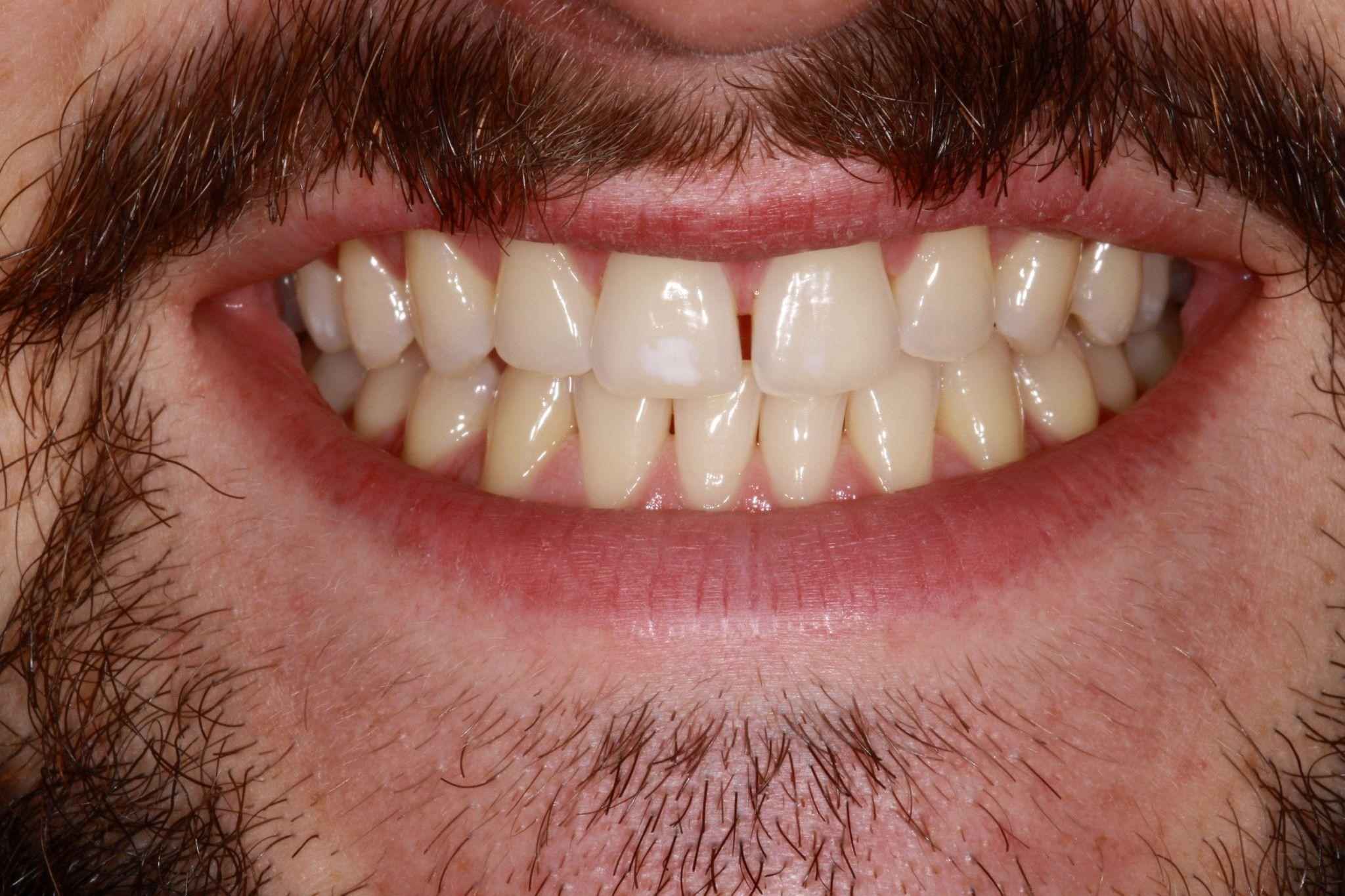 veneers-and-iInvisalign-case-3 veneers-and-iInvisalign-case-3