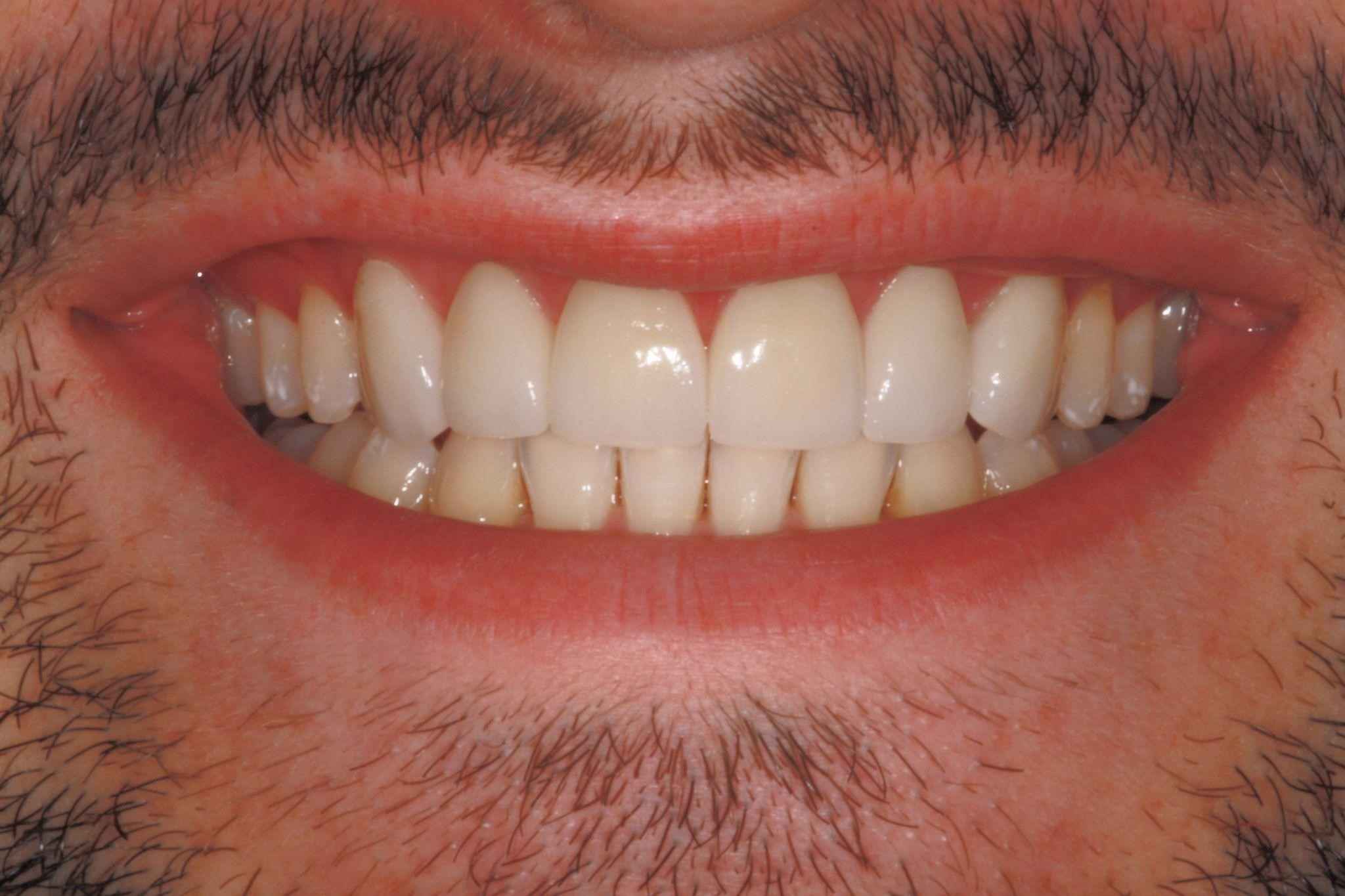 veneers-and-iInvisalign-case-4
