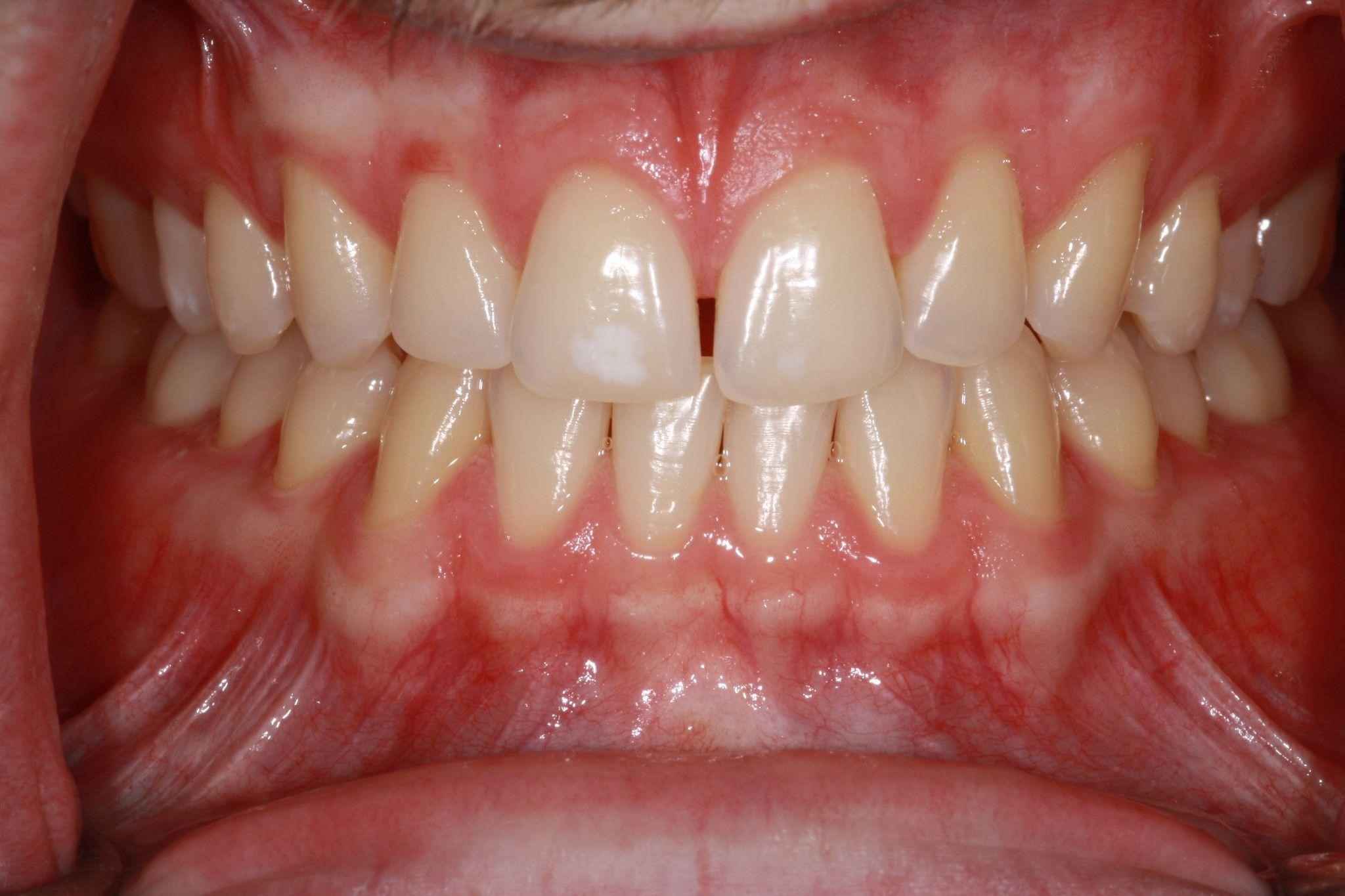 veneers-and-iInvisalign-case-5 veneers-and-iInvisalign-case-5