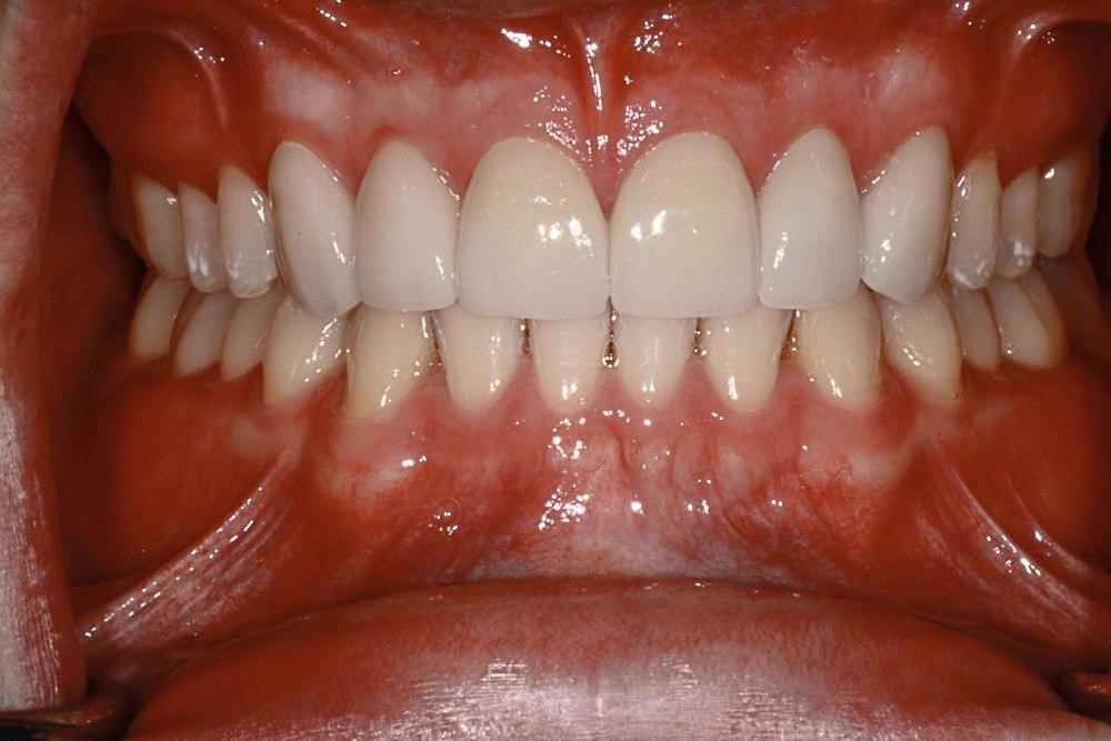 veneers-and-iInvisalign-case-6
