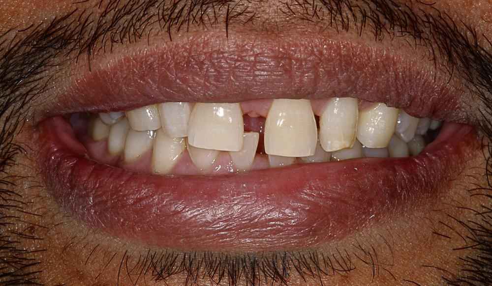 veneers-and-iInvisalign-case-9 veneers-and-iInvisalign-case-9