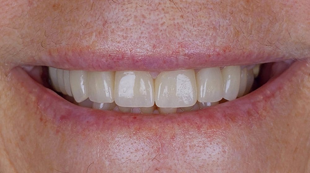 veneers-ba-3-after-new