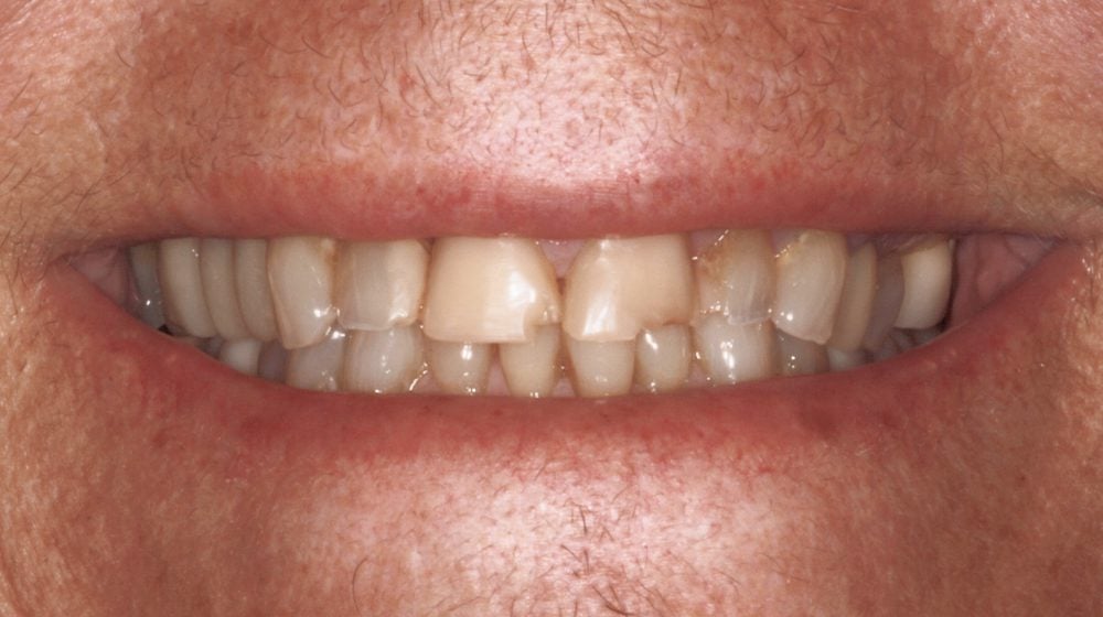 veneers-ba-3-before-new veneers-ba-3-before-new