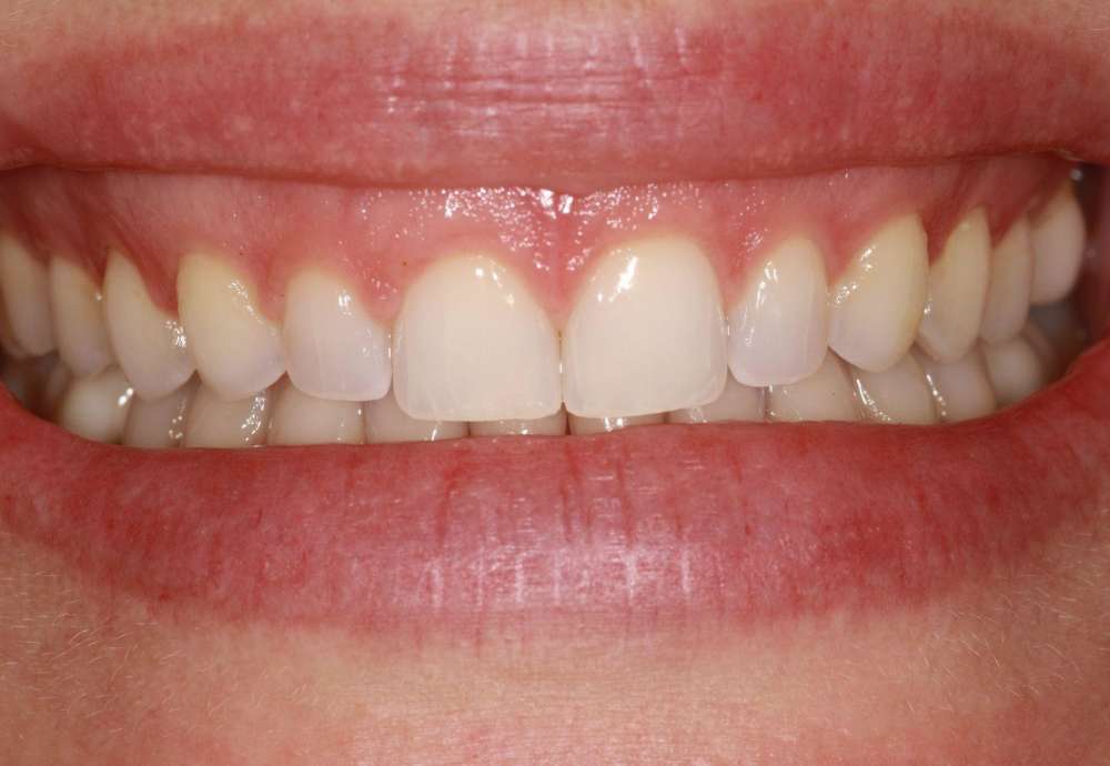 Laser-Gummy-Smile-Reduction-After-IMG Laser-Gummy-Smile-Reduction-After-IMG