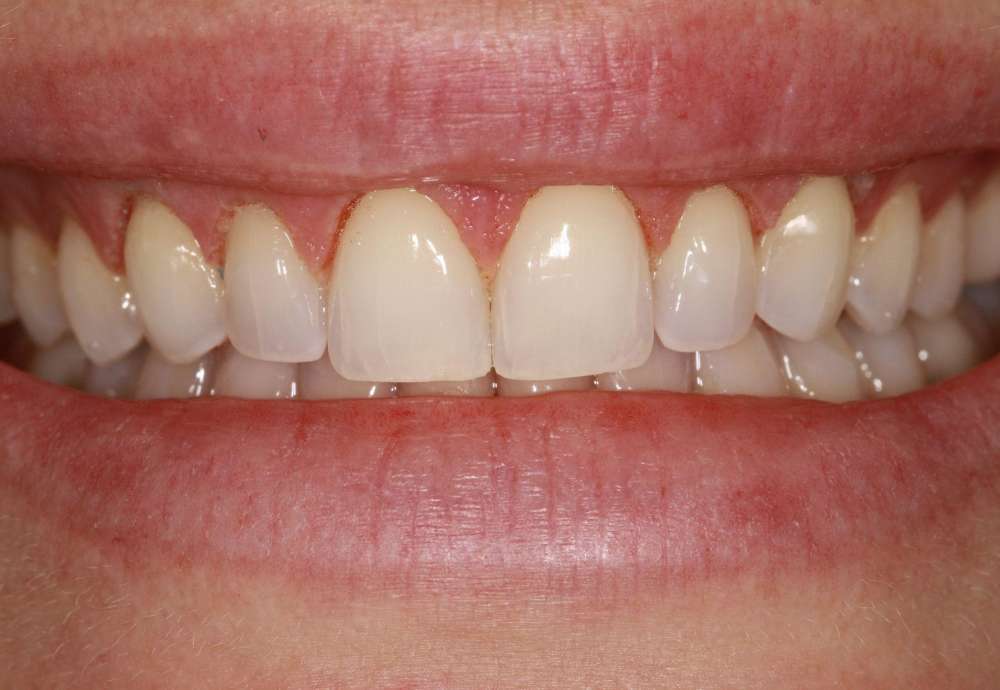 Laser-Gummy-Smile-Reduction-Before-IMG