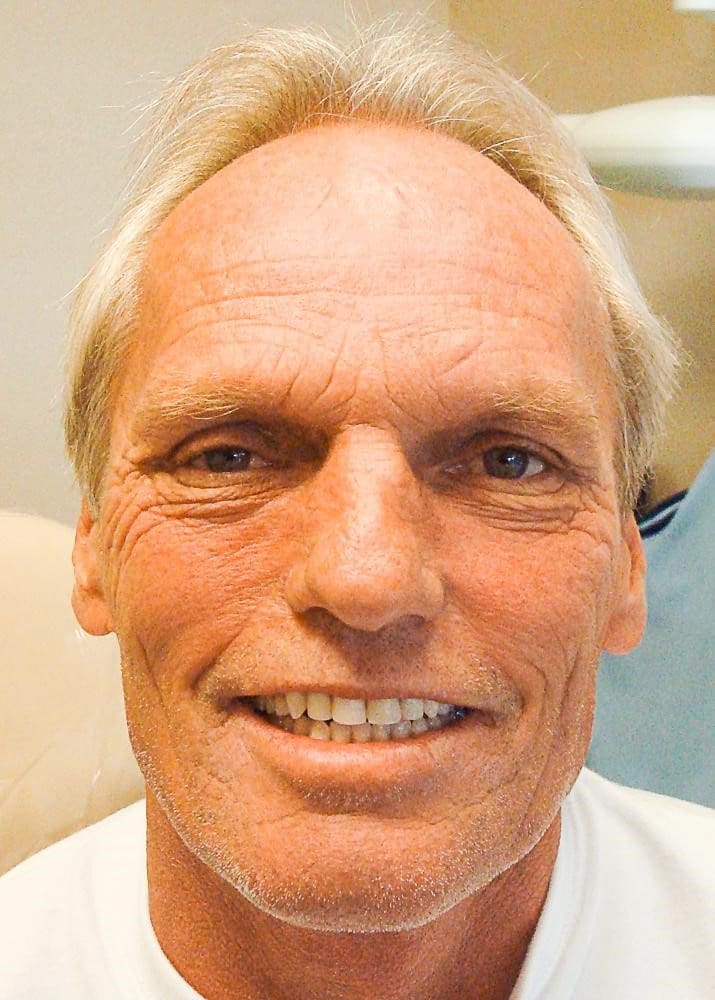 dentures-and-Implants-case-after