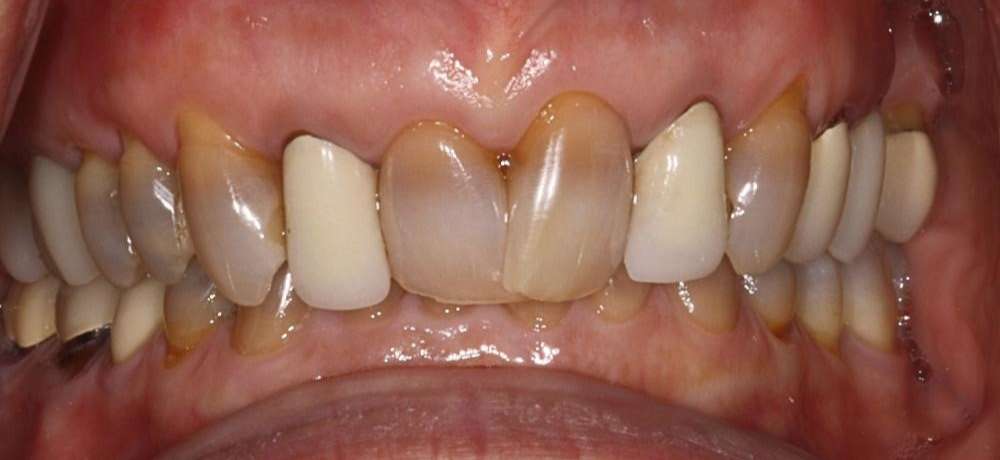 Cosmetic-Dentistry-Case-2-Part-3 Cosmetic-Dentistry-Case-2-Part-3