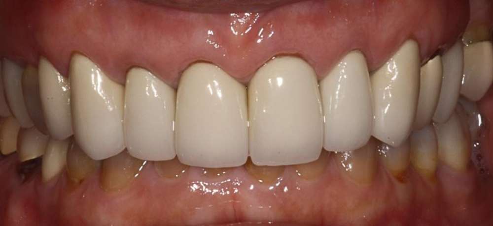 Cosmetic-Dentistry-Case-2-Part-4